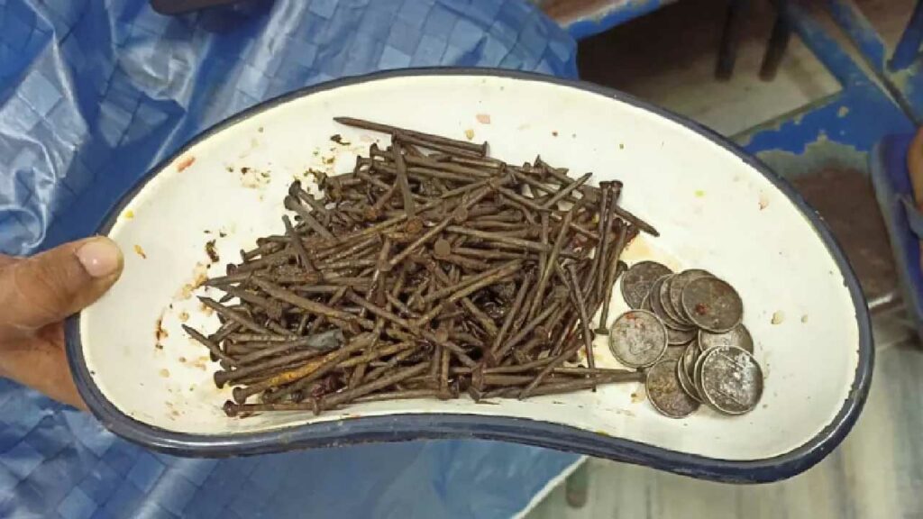 During the surgery- 250 nails- 35 coins and a stone were found